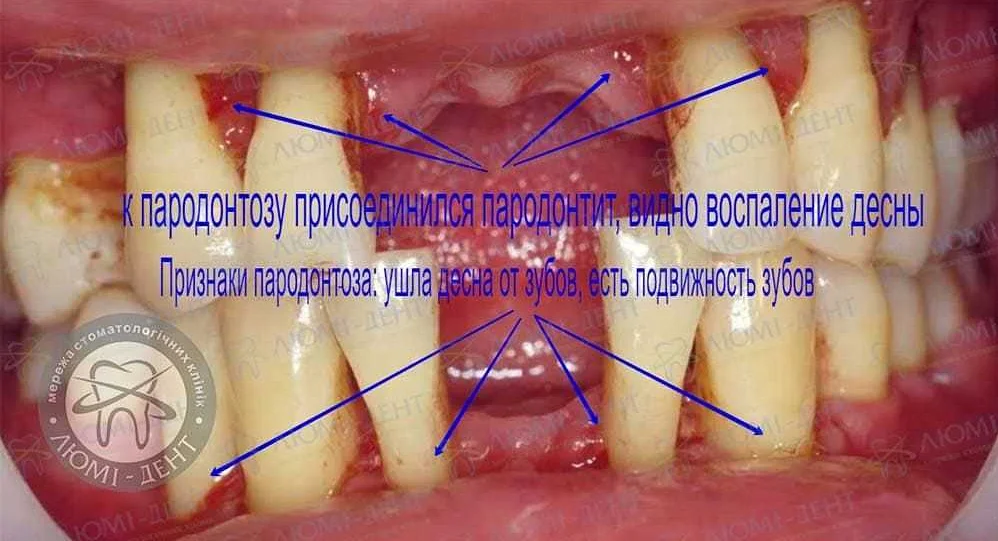 Регулярные посещения стоматолога для профилактики пародонтоза