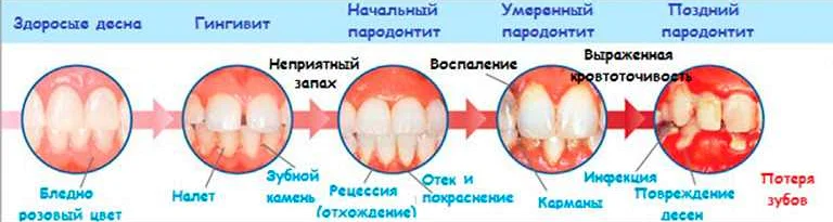 Забудьте о проблемах с пародонтозом благодаря регулярным визитам к стоматологу