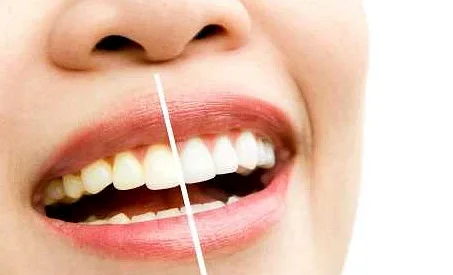 Регулярность чистки зубов: важность для здоровья полости рта