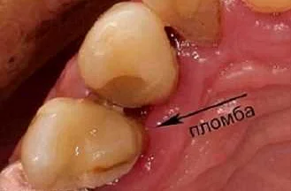 Профилактика зубного кариеса при гормональных нарушениях