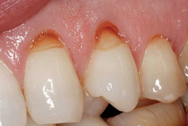 Гормональные изменения и здоровье зубов
