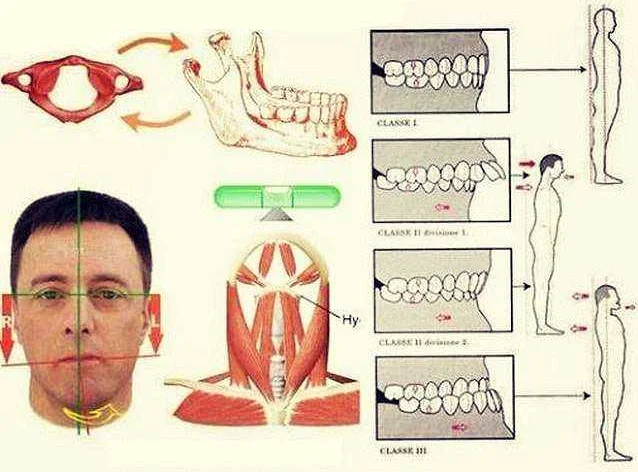 Исправление дефектов при помощи ортодонтических аппаратов