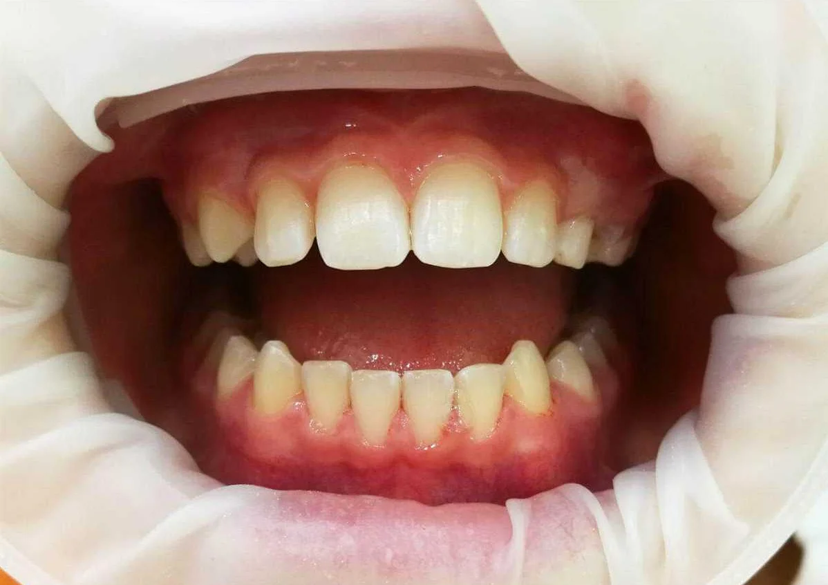 Почему зубной налет возникает у детей и как с ним бороться
