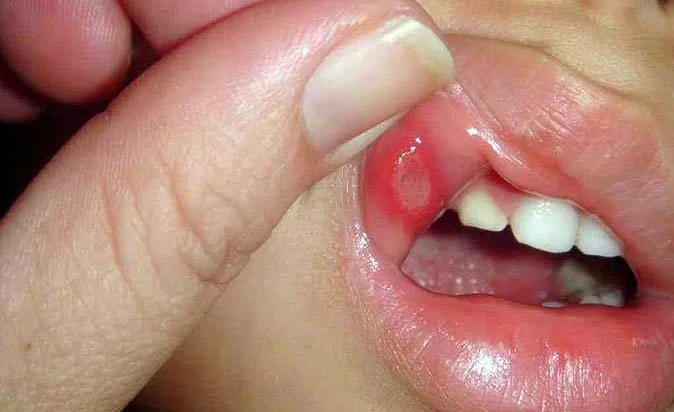 Стоматит - правила гигиены полости рта