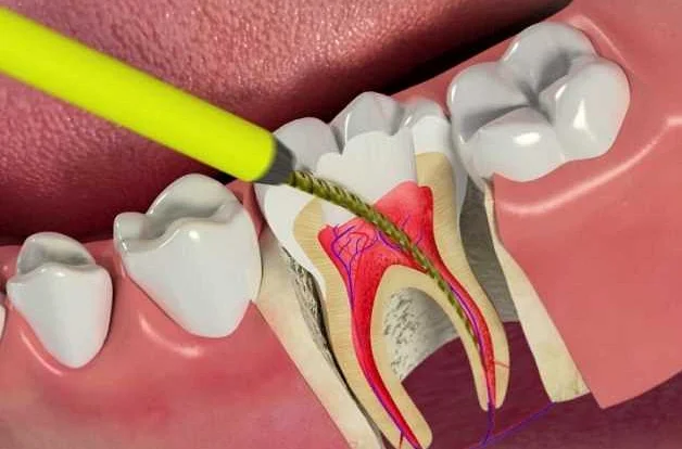 Восстановление зуба после эндодонтии