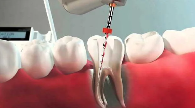 Является ли эндодонтия способом спасения зубов