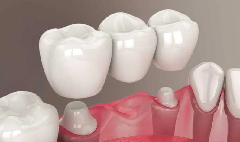 Надежное и эффективное решение проблемы потери зубов