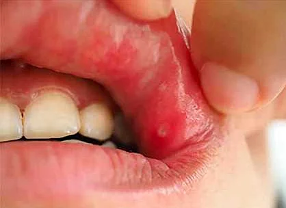Ранние симптомы заболевания желудочно-кишечного тракта, выражающиеся в полости рта
