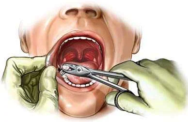 Показания к удалению зубов