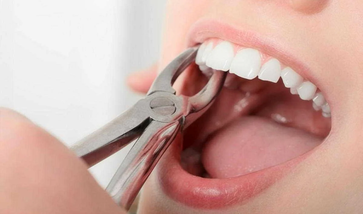 Сам процесс удаления зубных корней