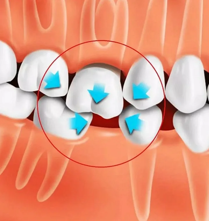 Опасности и последствия неудаления патологических зубов