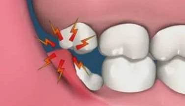 Медицинские показания для удаления зубов