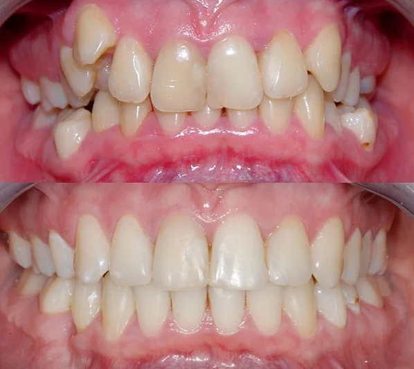 Удаление зубов: причины, последствия и замещение