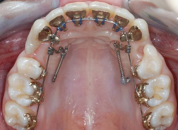 Важность регулярных визитов к стоматологу после удаления зубов