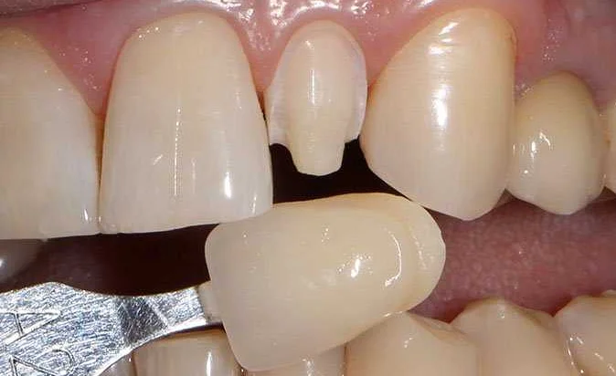 Как виниры способствуют восстановлению утраченных зубов
