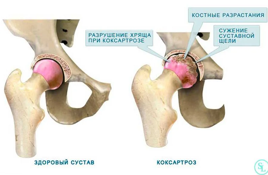 Как определить приступ артрита ступней и как он связан с коксартрозом?