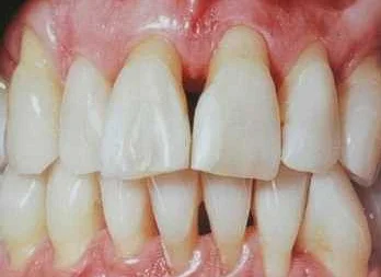 Причины, по которым курение вредно для зубов и десен