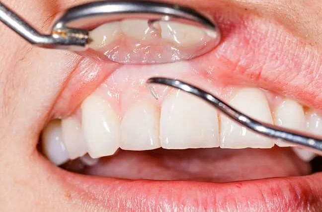 Влияние зубного протезирования на дыхательную функцию