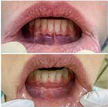 Период после операции: забота о полости рта
