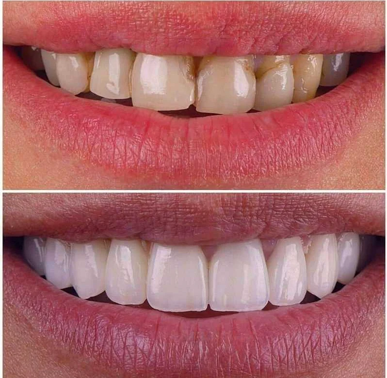 Плюсы и минусы виниров для восстановления зубов