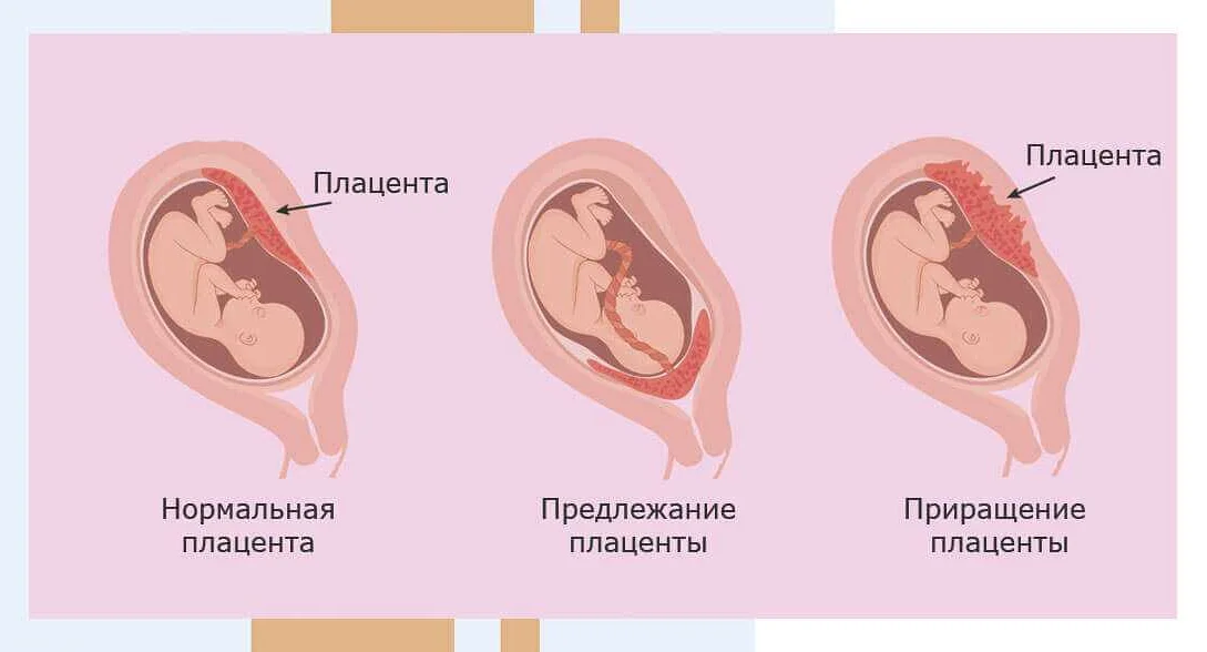 Защита от беременности при использовании других видов контрацепции