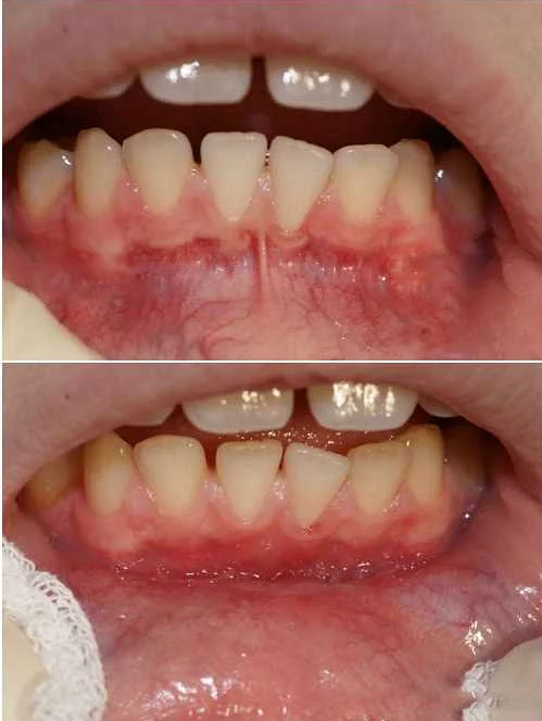 Восстановление после операции в полости рта: максимизация потенциала восстановления