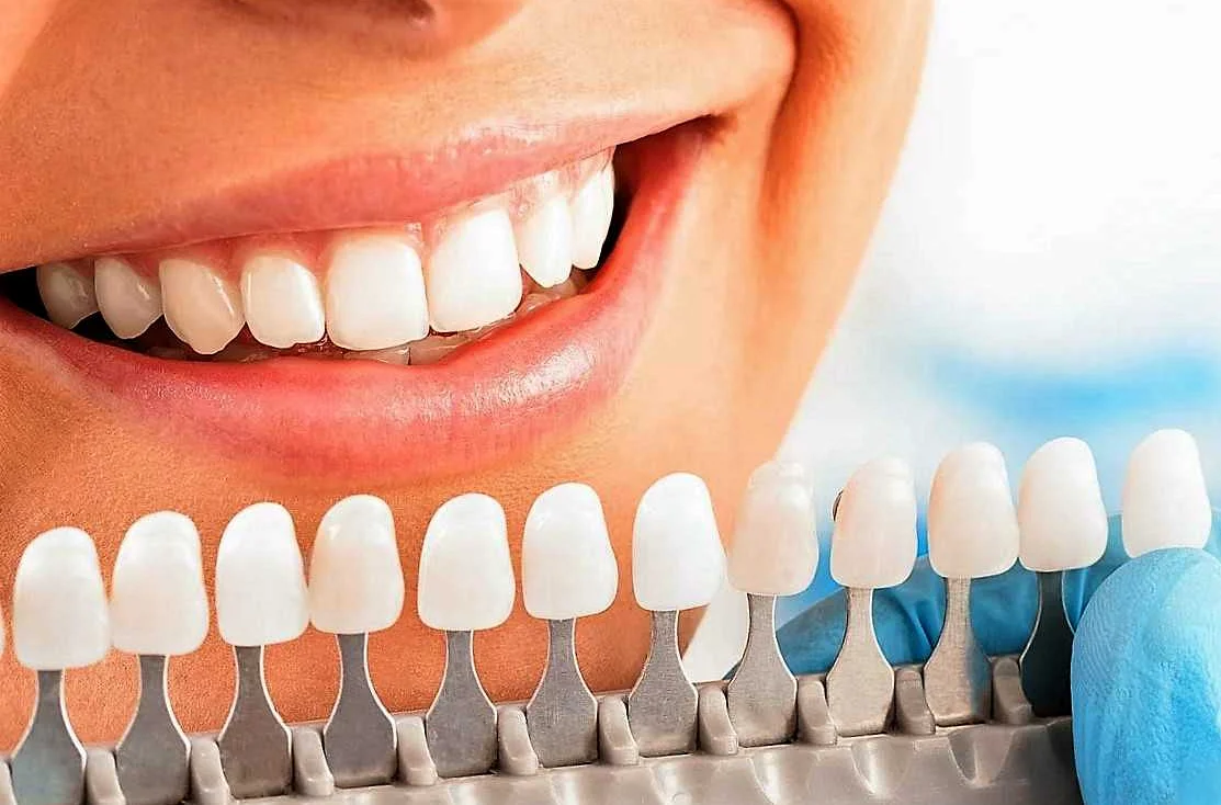 Отбеливающие полоски для зубов как эффективный вариант