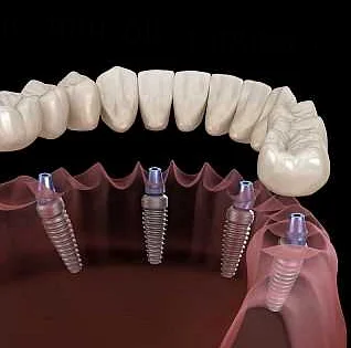 Протезирование зубов: отличительные черты и польза [Оральная хирургия, Стоматология и Общее Здоровье]