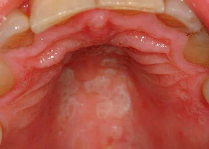 Связь заболеваний полости рта с общим здоровьем