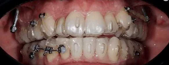 Влияние зубов на состояние легких