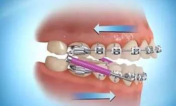 Эффективное использование зубной нити и аппаратов для исправления прикуса