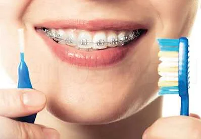 Зубная щетка для брекетов: особенности и советы пациентам