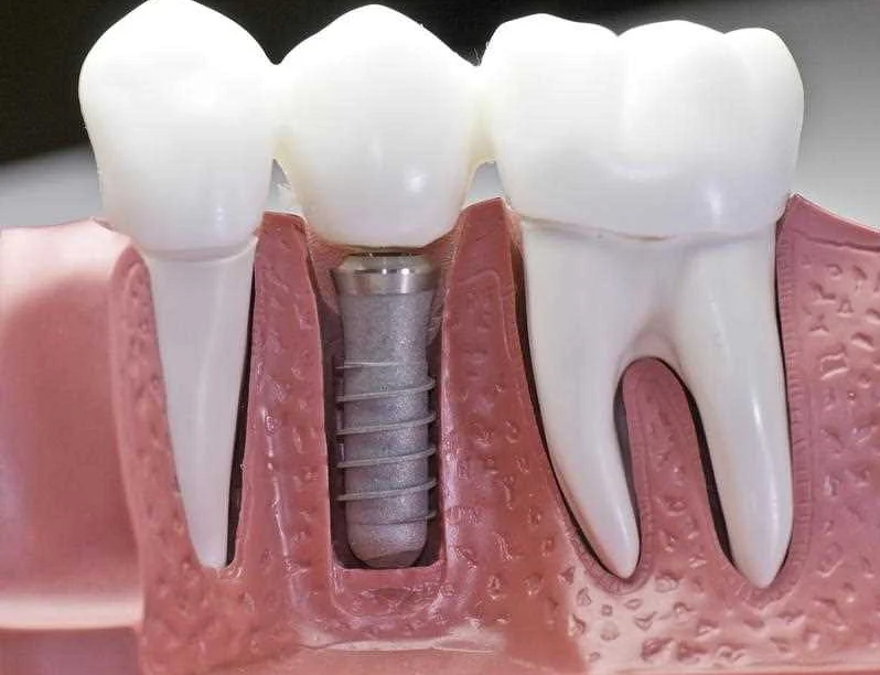 Роль зубных имплантатов в ортопедической стоматологии
