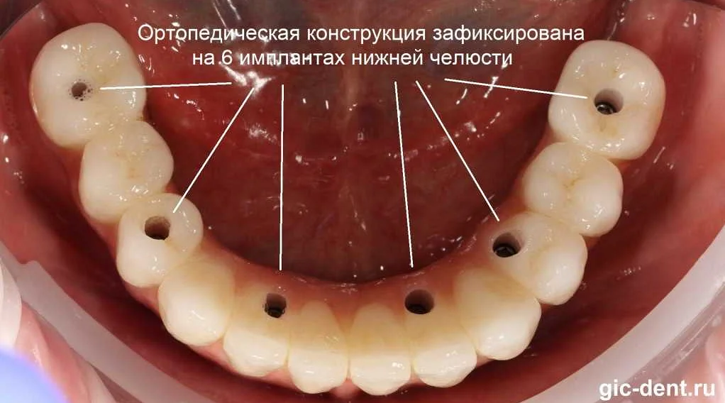 Ожидаемые перспективы развития зубных имплантатов в ортопедической стоматологии